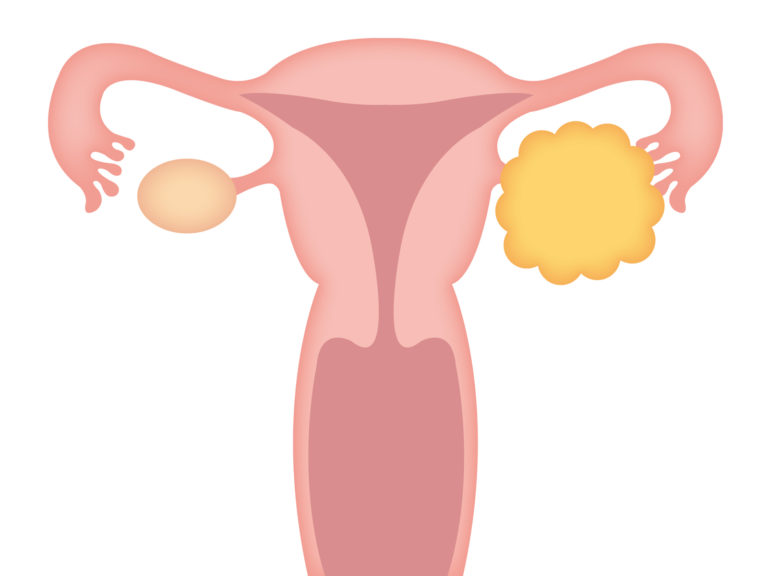 複雑性卵巣嚢腫とは何ですか?